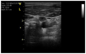 establishing-a-vte-risk-score-for-astronauts-algorithm
